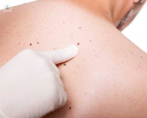 lunares-vs-melanoma-pon-atencion-a-tu-piel imagen de artículo