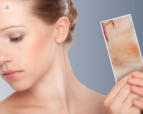Cómo eliminar las cicatrices por acné