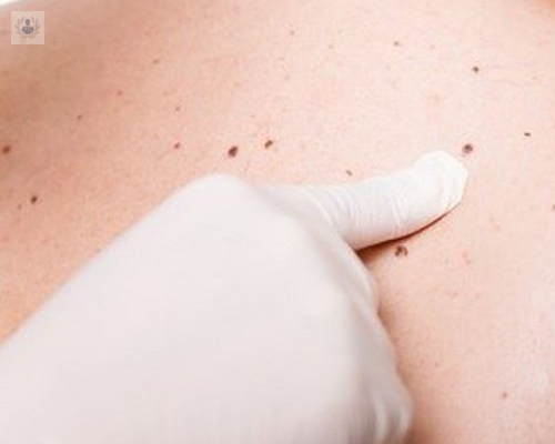 cancer-en-la-piel-cuando-acudir-con-un-especialista-en-dermatologia imagen de artículo