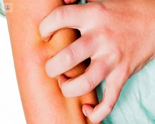 psoriasis-padecimiento-dermatologico-de-origen-genetico imagen de artículo