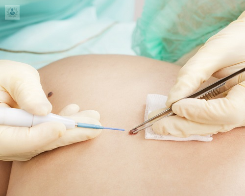 tratamiento-para-verrugas-por-que-eliminarlas imagen de artículo