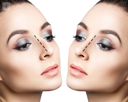 rinoplastia-o-cirugia-de-nariz-estetica-o-funcional imagen de artículo