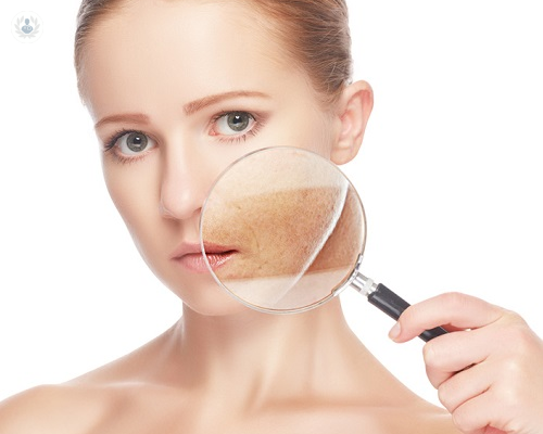 melasma-como-eliminar-las-manchas-en-la-piel imagen de artículo