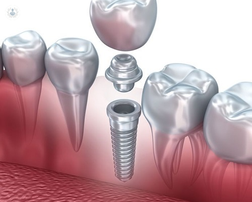 Diferentes tipos de implantes dentales