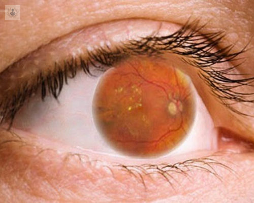 retinopatia-diabetica-como-afecta-la-vision imagen de artículo