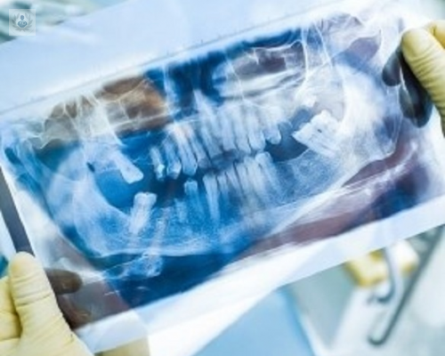 Importancia de los implantes dentales