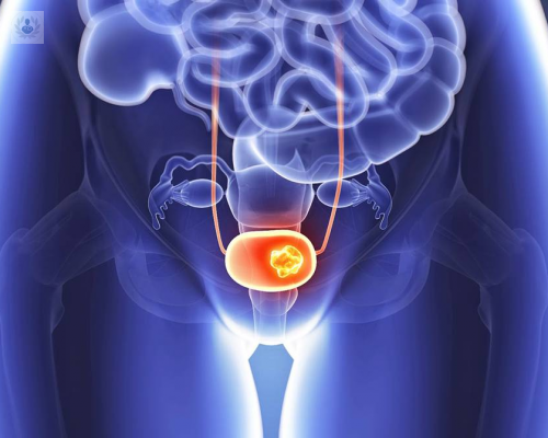 cancer-de-vejiga-un-diagnostico-a-tiempo-puede-salvarte imagen de artículo