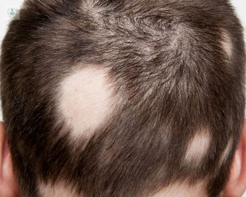 Tipos de Alopecia: diagnóstico y tratamientos