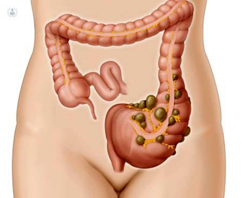 diverticulitis-sintomas-y-tratamiento imagen de artículo