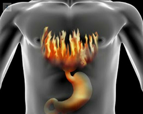 reflujo-gastroesofagico-existen-tratamientos-para-evitar-la-cirugia imagen de artículo