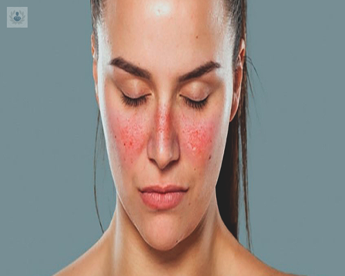 lupus-eritematoso-sistemico-una-enfermedad-autoinmune imagen de artículo