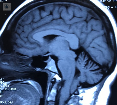 malformacion-de-chiari-tipo-i-mas-que-un-dolor-de-cabeza imagen de artículo