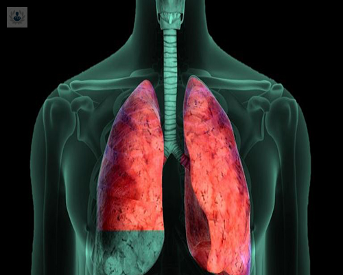 derrame-pleural-que-es-y-que-lo-causa imagen de artículo