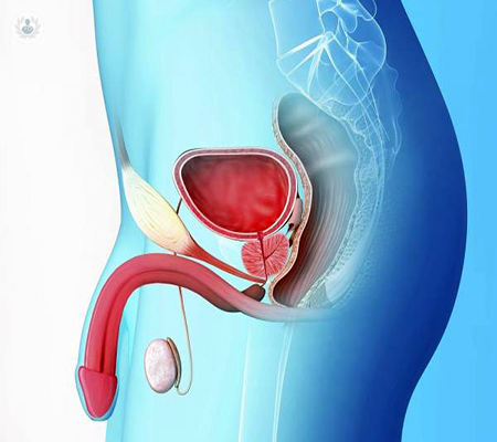 hiperplasia-benigna-prostatica-que-es-y-como-tratarla imagen de artículo