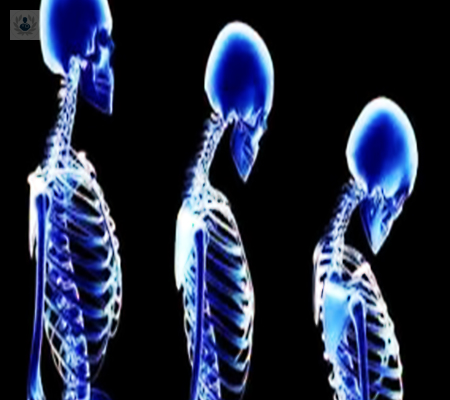 Osteoporosis: El desgaste continuo de los huesos