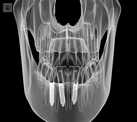 implantologia-basal-y-su-uso-para-el-tratamiento-de-la-mandibula-atrofica imagen de artículo