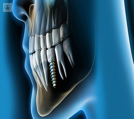 La implantología y sus funciones