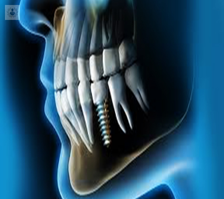implantes-dentales-el-poder-de-una-dentadura-sana-y-estetica imagen de artículo