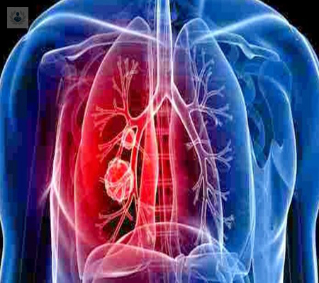 fibrosis-quistica-un-gen-potencialmente-mortal imagen de artículo