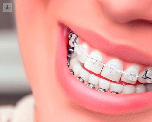 Brackets: la solución para dientes rectos y perfectos