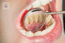 La acumulación de la Placa Bacteriana: enemiga número uno de los dientes