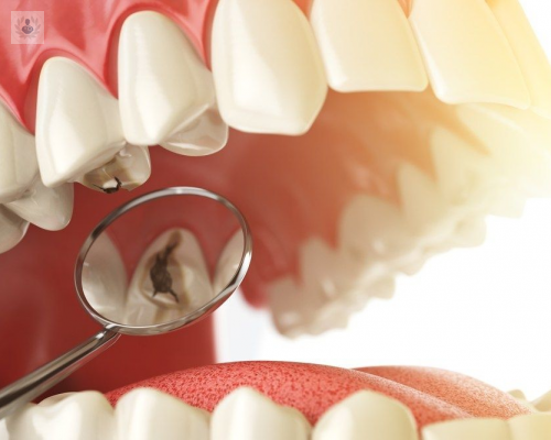 consejos-para-evitar-las-caries imagen de artículo