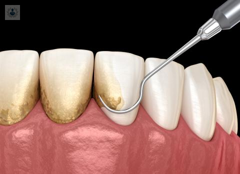 7 claves para prevenir la placa dental 