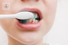 ¿Te sangran las encías después del cepillado? Señal de alarma para tus dientes