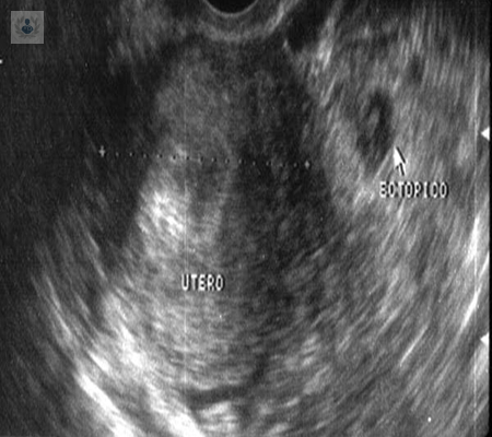 causas-y-sintomas-de-un-embarazo-ectopico imagen de artículo