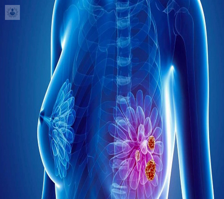 el-abc-del-cancer-de-mama imagen de artículo