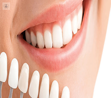 blanqueamiento-dental-como-se-realiza imagen de artículo