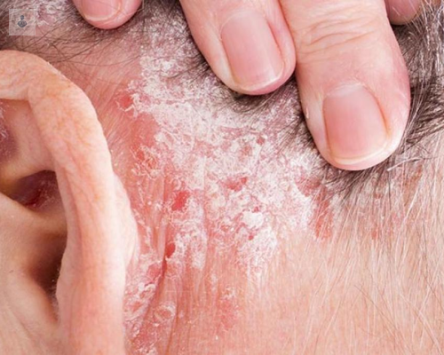 Psoriasis, una Enfermedad Crónica de la piel 