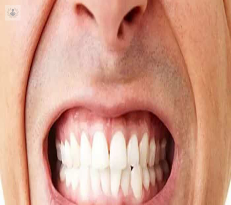 bruxismo-por-que-aprieto-los-dientes imagen de artículo