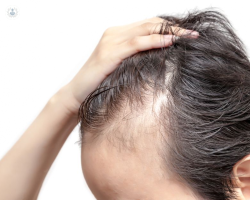 Alopecia, un problema en ambos sexos