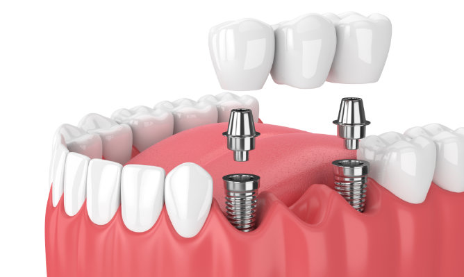 que-son-los-implantes-con-carga-inmediata imagen de artículo