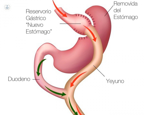 cirugia-bariatrica-quien-puede-acceder-a-ella imagen de artículo