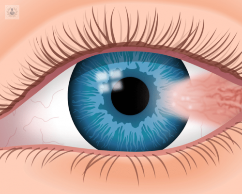 pterigion-una-patologia-ocular-invasiva imagen de artículo