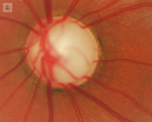 Glaucoma: Enfermedad ocular silenciosa (Parte 2)