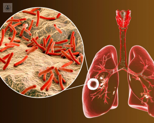 dia-mundial-contra-la-tuberculosis imagen de artículo