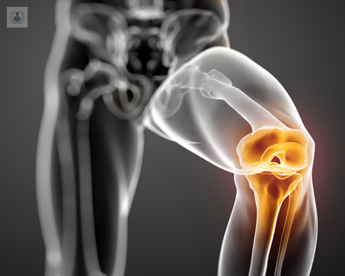 Lesión de meniscos: una lesión mínima que puede desencadenar en daños articulares severos