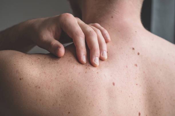 prevenir-disminuir-el-riesgo-de-melanoma imagen de artículo