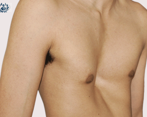 pectus-excavatum-pe-reflejo-estetico imagen de artículo