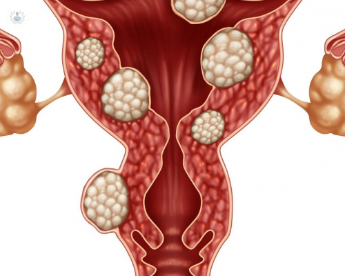 Miomas uterinos: un problema genético, hereditario u hormonal que afecta a más del 50% de las mujeres