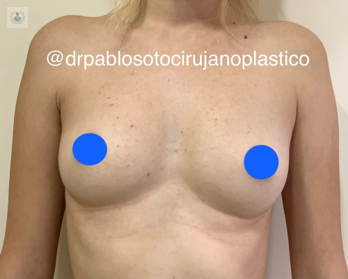 mamoplastia-de-aumento-la-cirugia-mas-frecuente-en-el-campo-de-la-medicina-estetica imagen de artículo