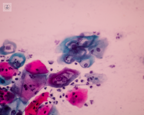 Virus de Papiloma Humano: La infección de transmisión sexual más común de nuestros tiempos