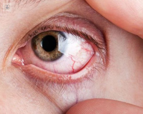 el-glaucoma-tiene-cura imagen de artículo