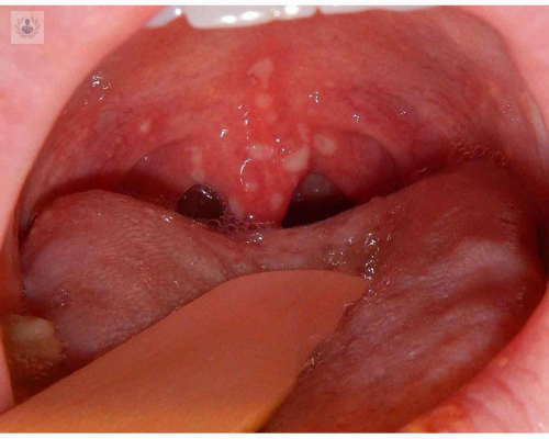 tumores-bucales-como-se-diagnostican-y-cual-es-el-tratamiento imagen de artículo