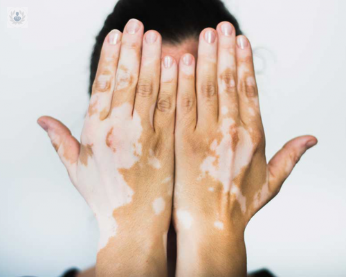 conoce-los-multiples-tratamientos-contra-el-vitiligo imagen de artículo