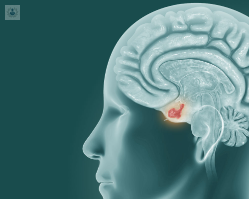 Adenoma de Hipófisis: uno de los tumores más frecuentes del sistema nervioso central