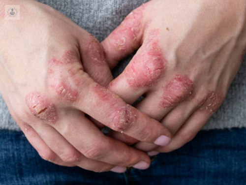 Estudio: 15% de los jóvenes con Dermatitis Atópica pierden días de clase